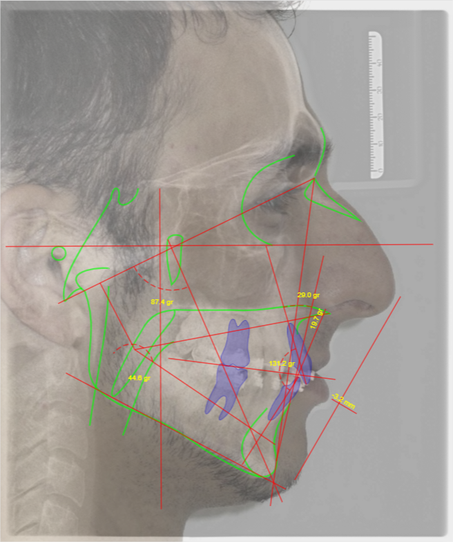 telerradiografia sobreposta